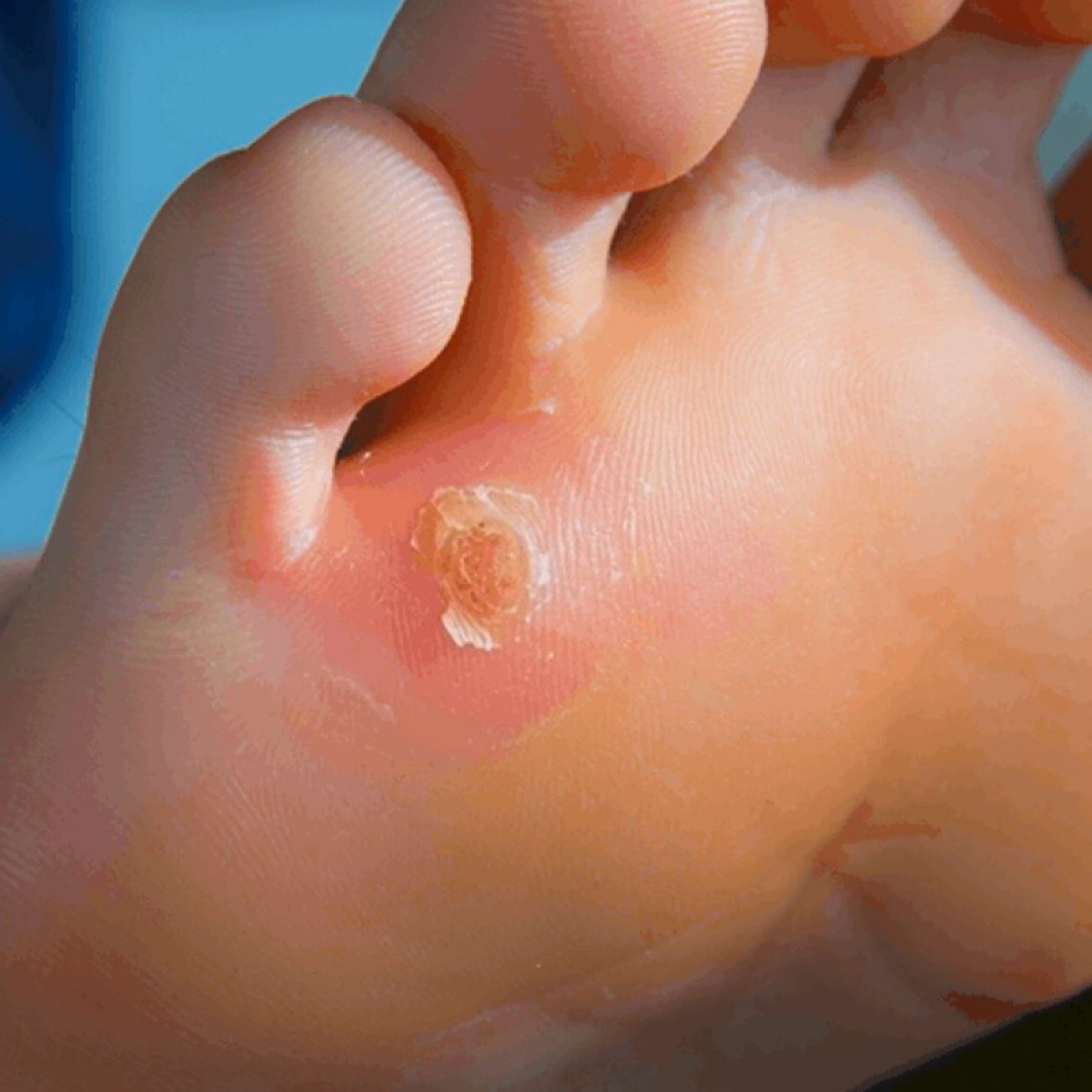 Corn And Callus Treatment (1 Corn) at Teas Podocenter in Ardmore, PA