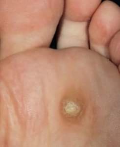 Corn Removal (1 Corn Treatment)