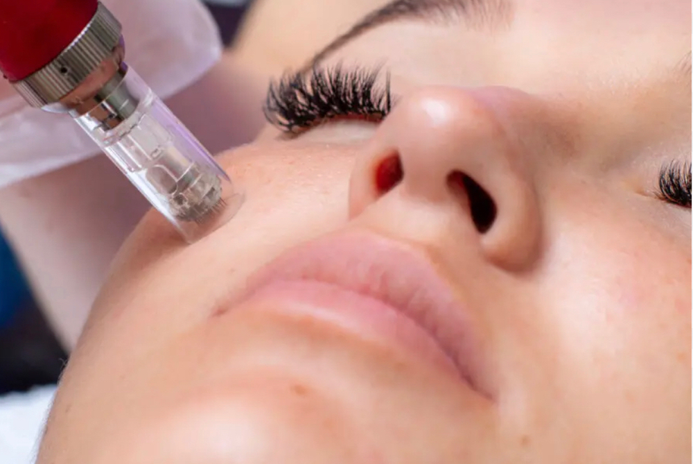 Microneedeling