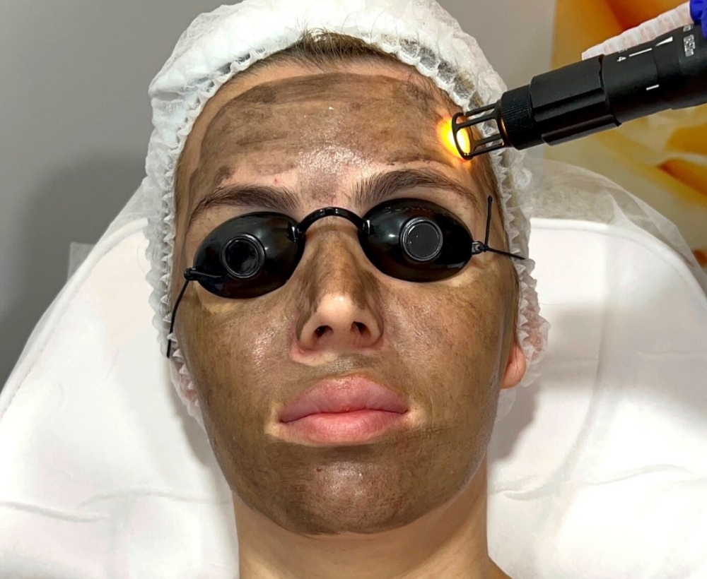 Hollywood Carbon Facial
