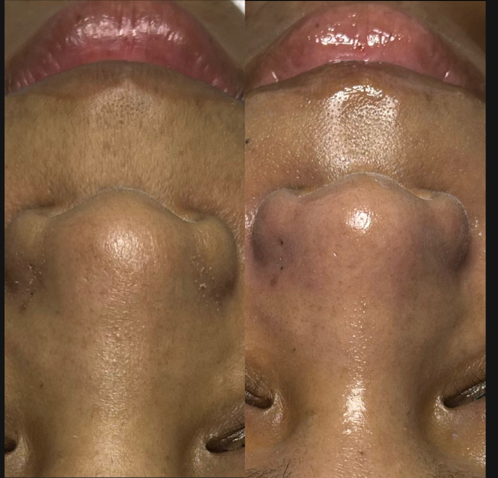 Decongesting Facial