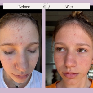 Teen- focused facials at Marco Island Aesthetics