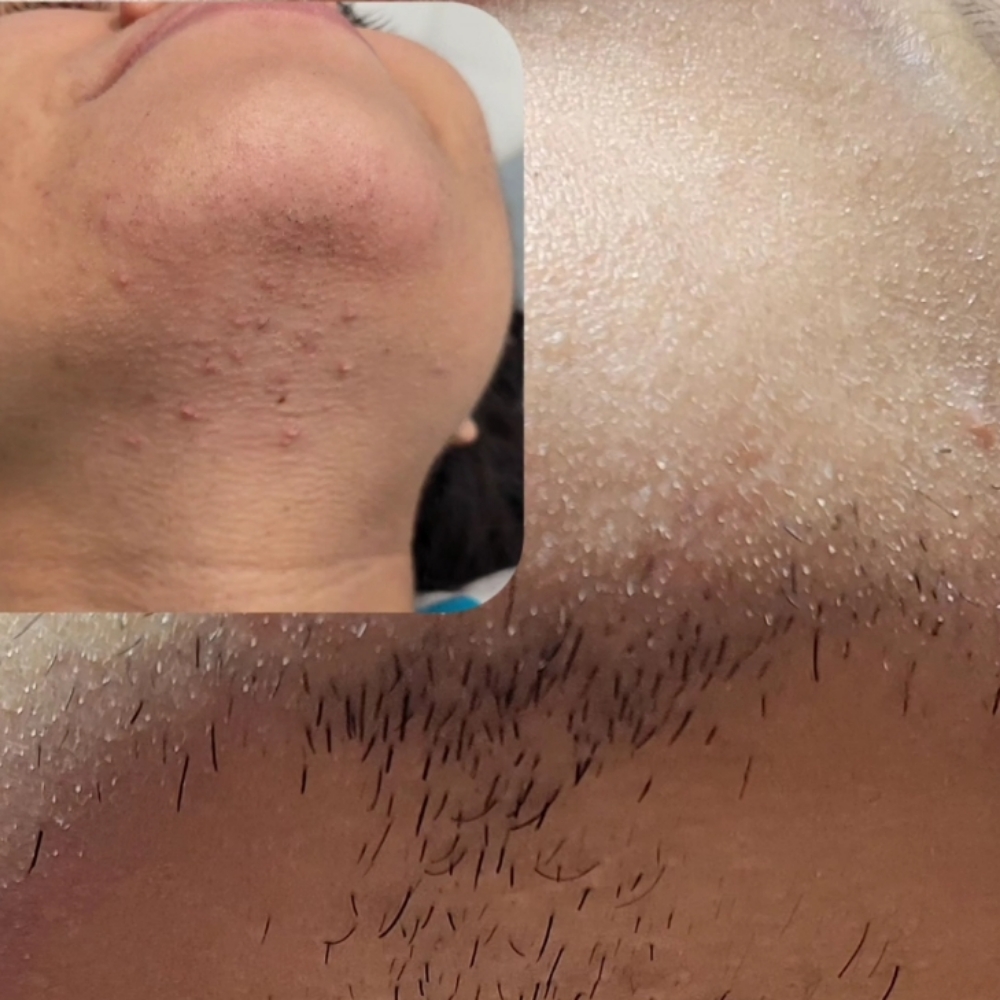 Hirsutism Wax at KMED Spa LLC in East Orange, NJ