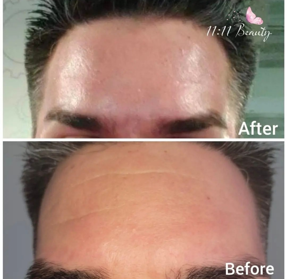 Forehead