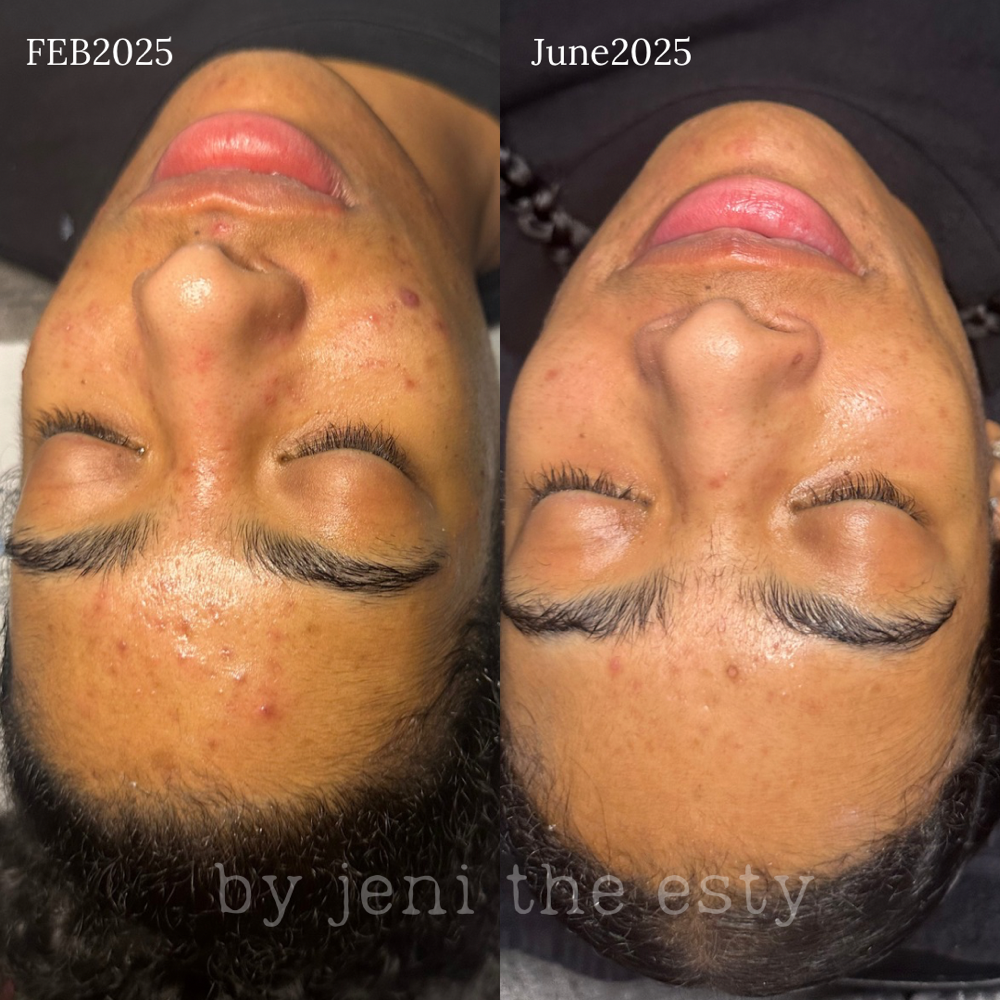 Customized Facial