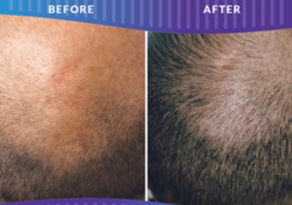 Procell Hair Regrowth Treatment at Barevia in Tempe, AZ