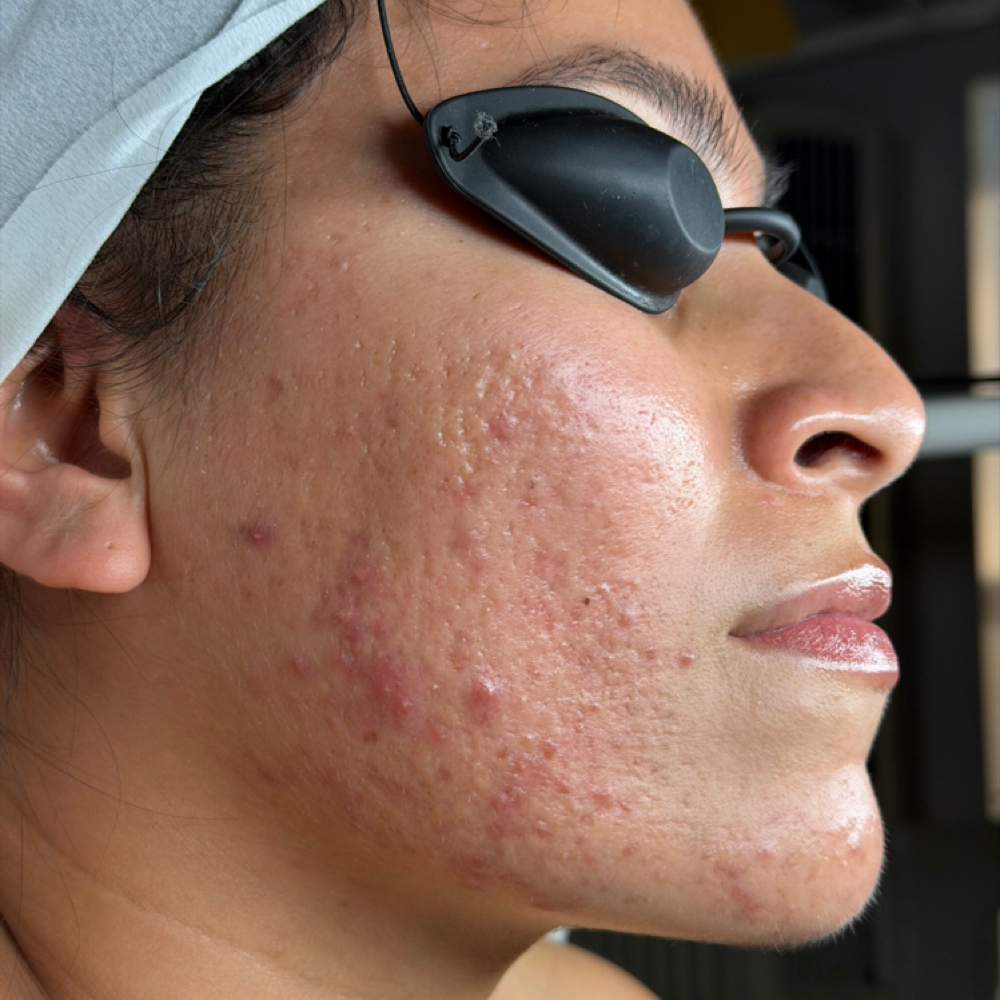 Acne Program at Poised Esthetics & Co. in Marietta, GA