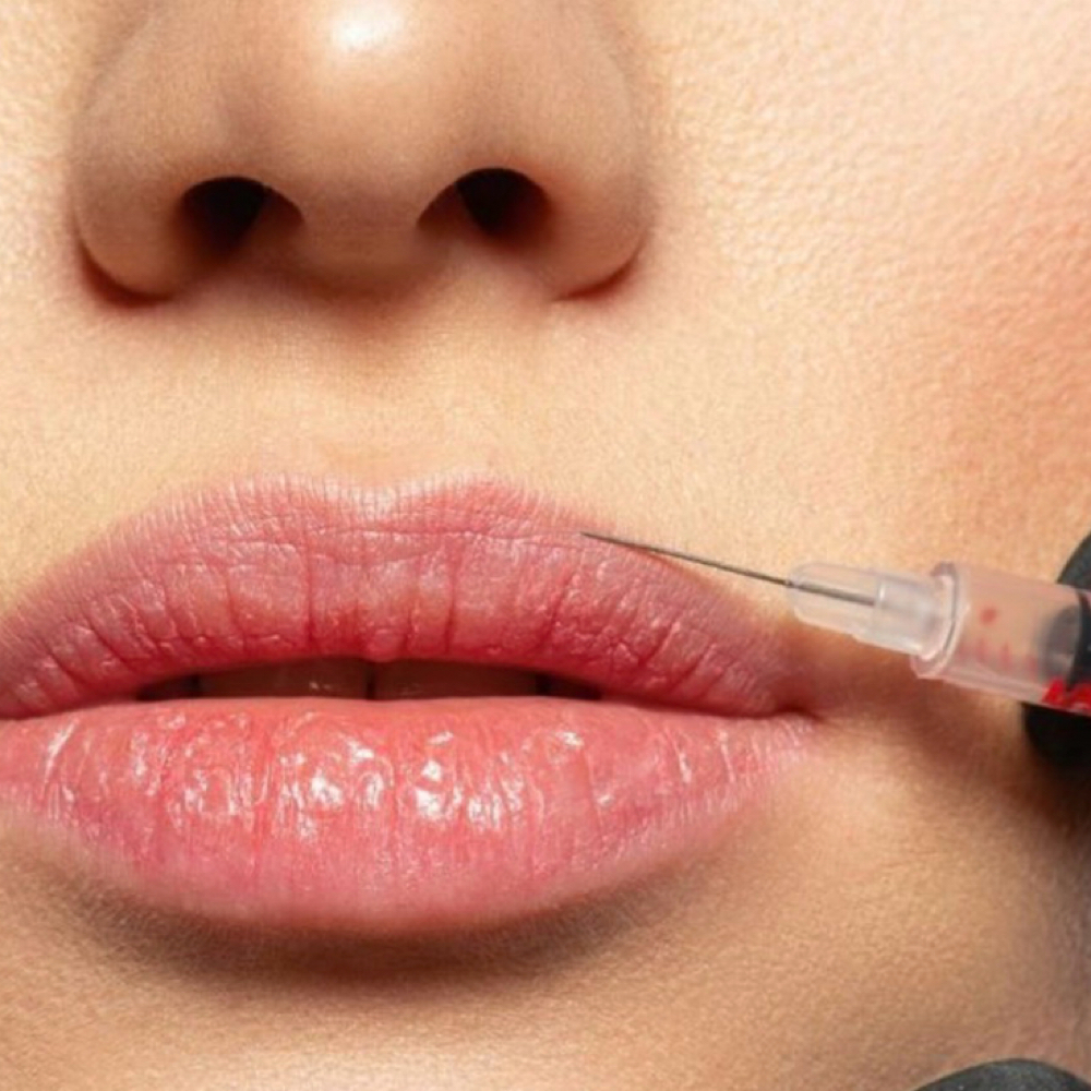 Lip Flip at Precision Aesthetics LLC in Harrodsburg, KY