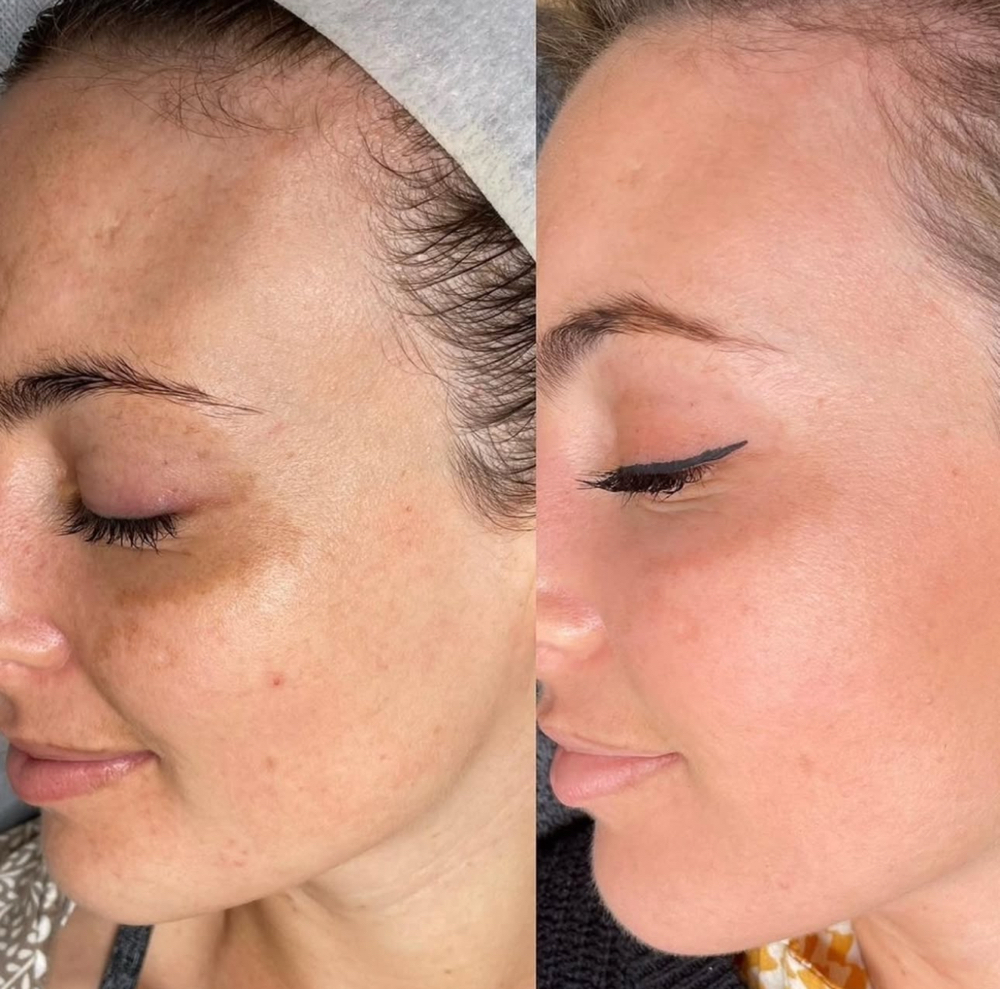 Microneedling With PRP