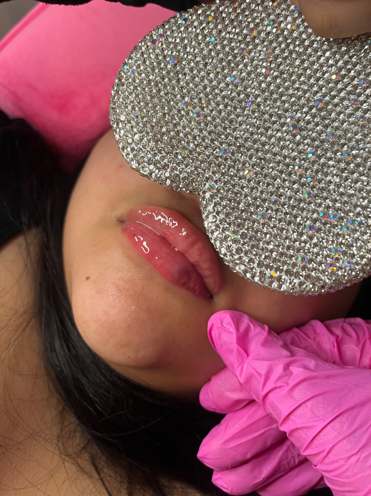 Hyluron Pen Lip Filler Full
