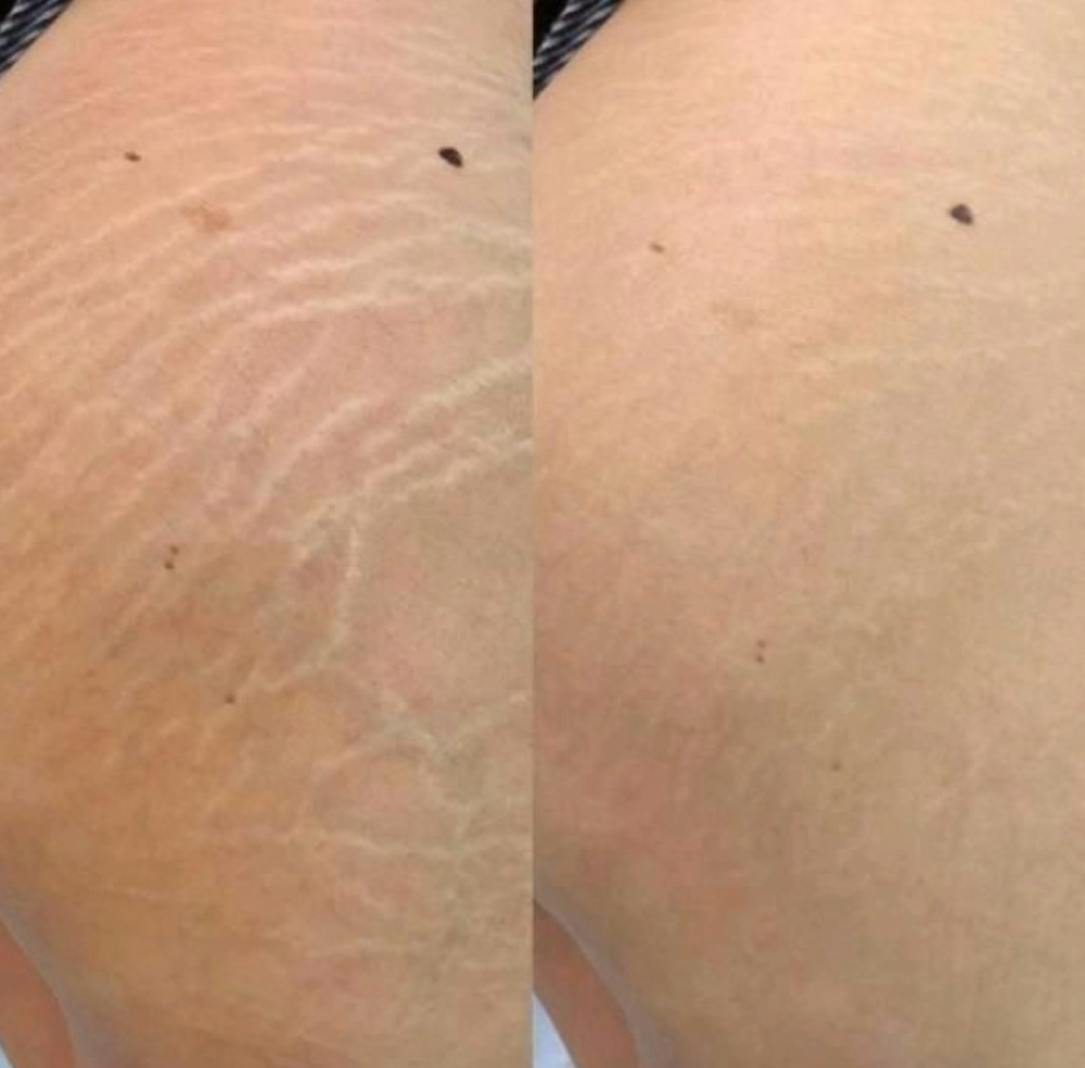 Stretch Mark Camouflage at Simply Snatched in Nevada, MO