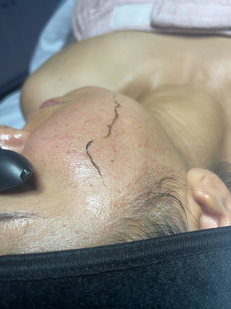 Dermaplaning Add On