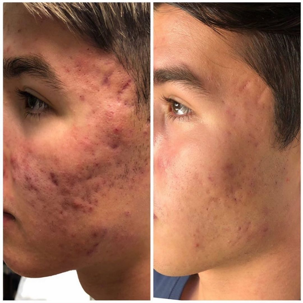 Acne Treatments