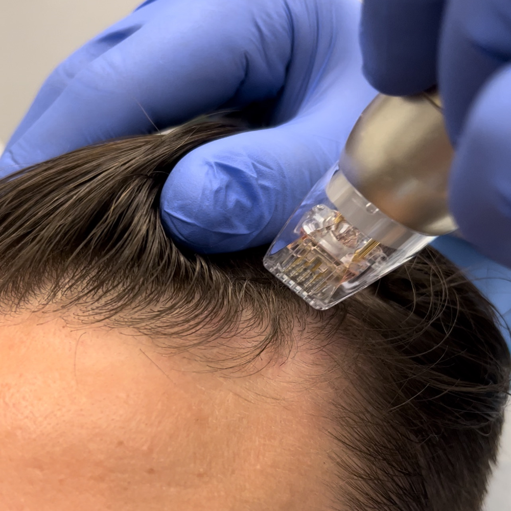 PRP Hair / 4 Treatments