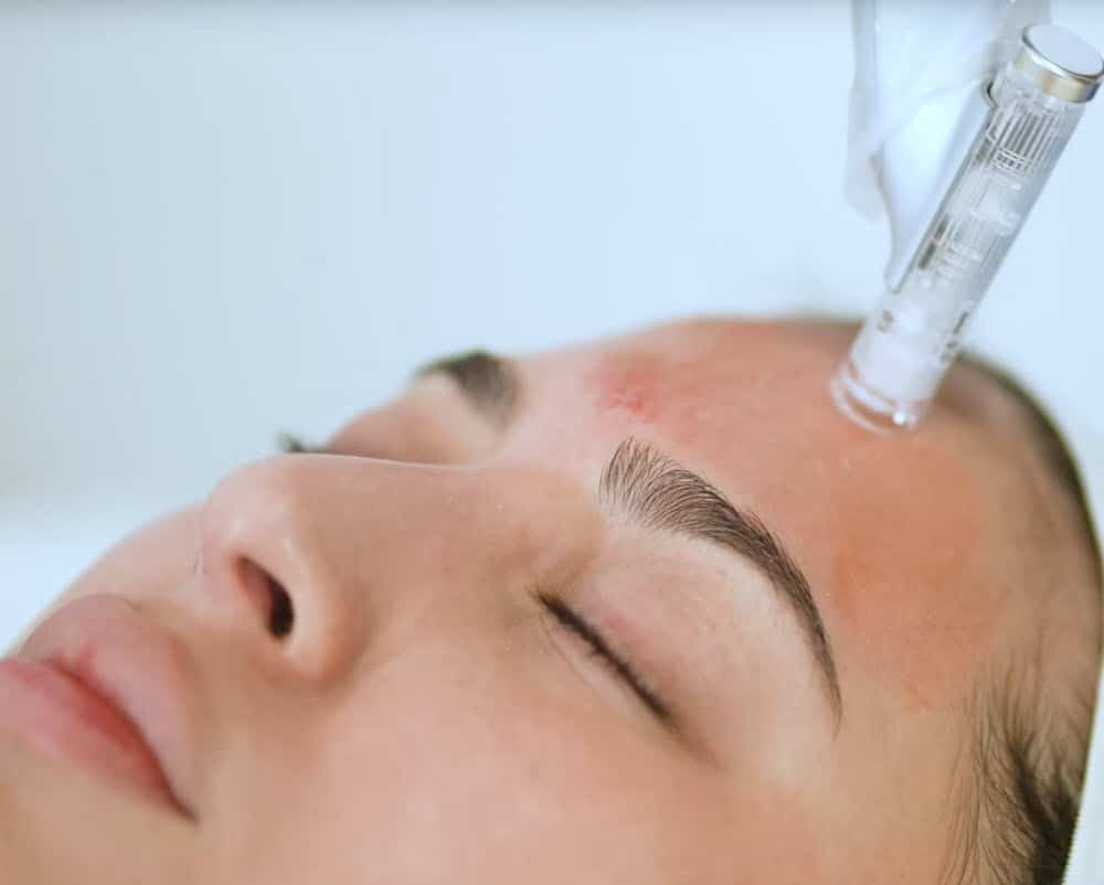 Microneedling