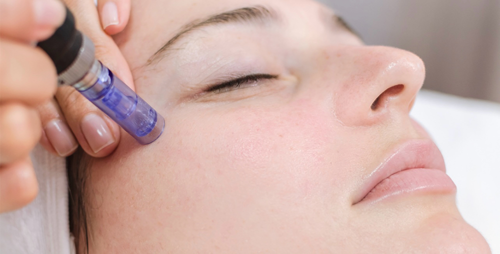 Micro-Needling