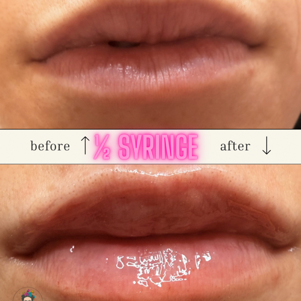 1/2 Syringe Lip Filler at Booking site for Mely & Kaila in Lubbock, TX