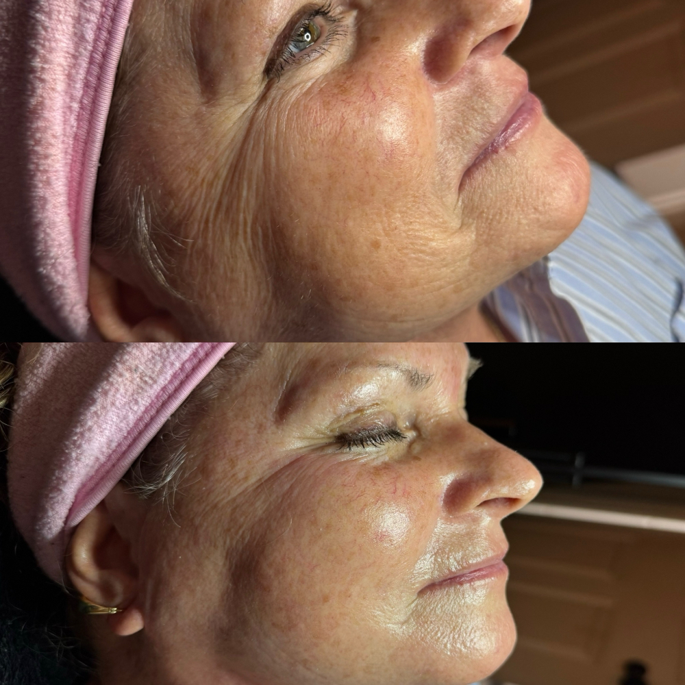 Better Than Botox Facial