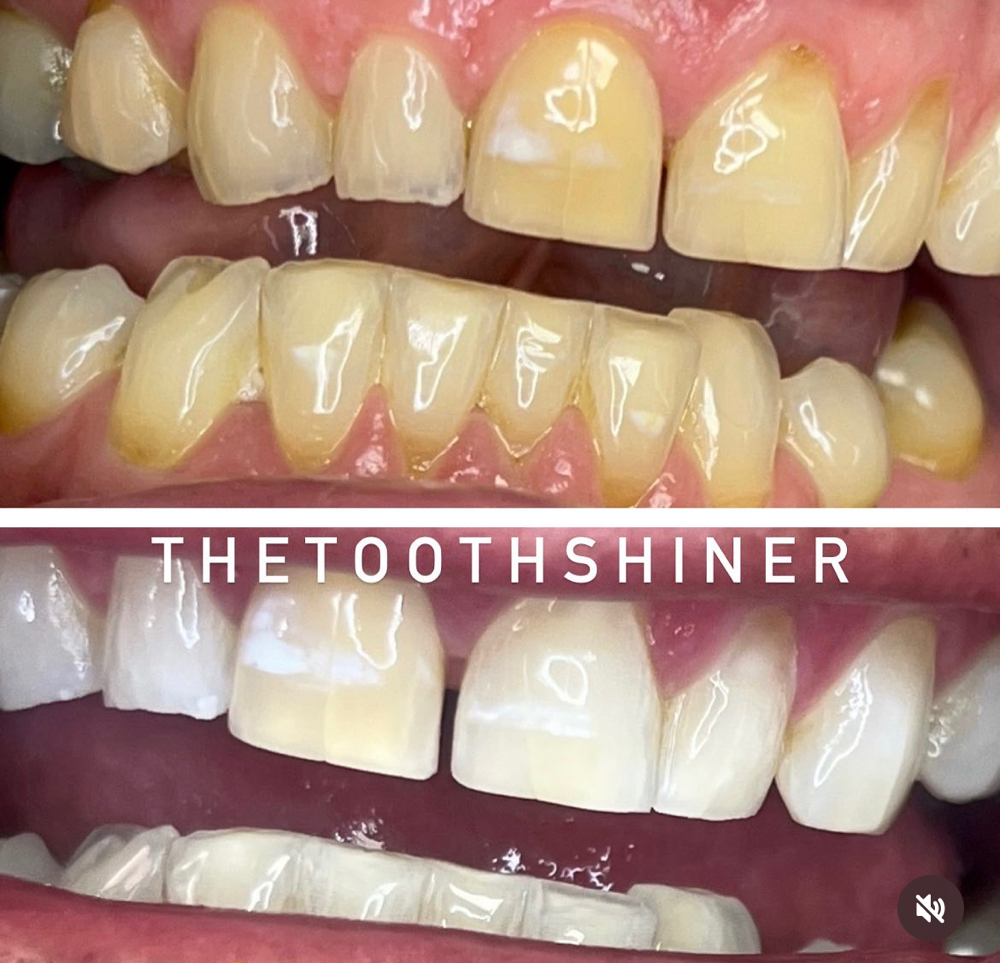 THE TOOTH SHINER DELUXE II