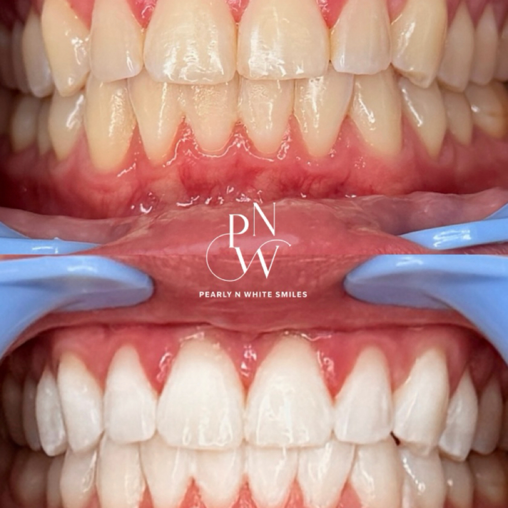 Member 30-Minute Whitening Session at Pearly N White Smiles in Salem, OR