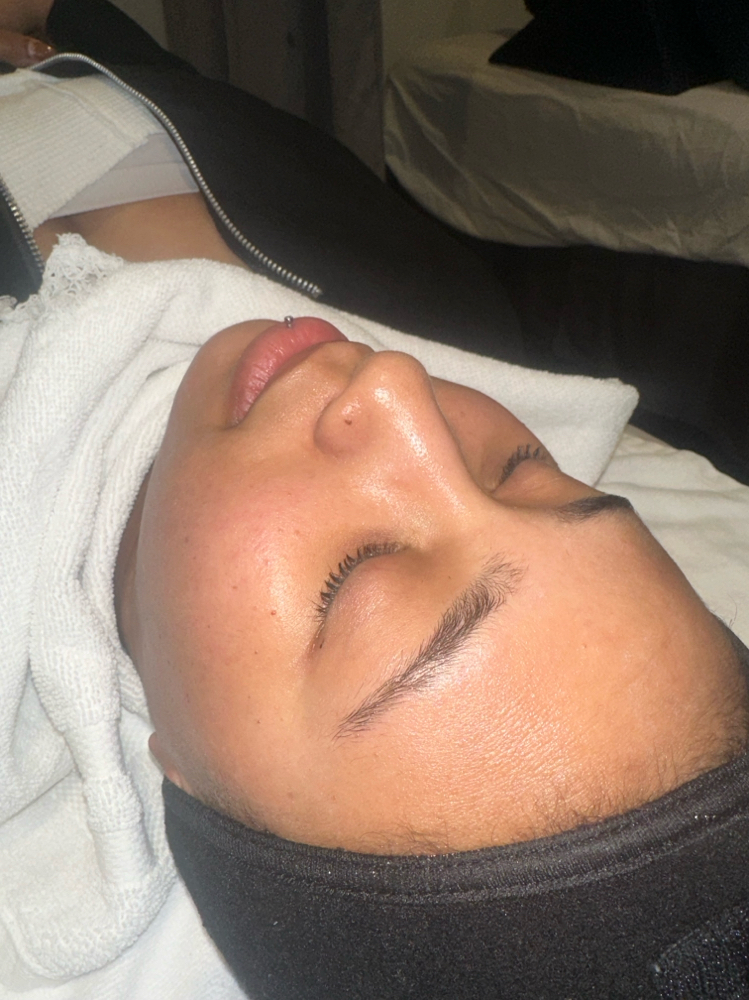 PCA Chemical Peel