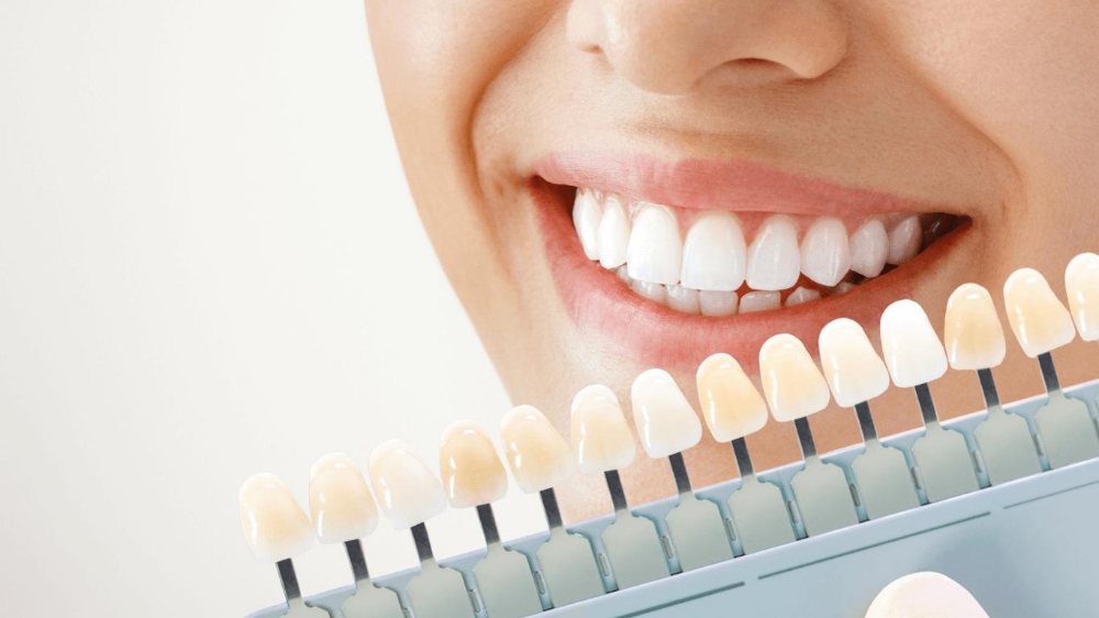 Teeth Whitening Service