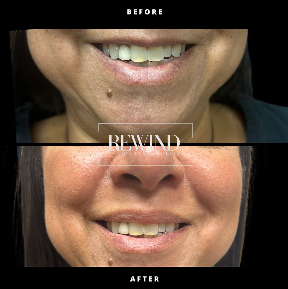 💋 Lip Flip with BOTOX® 💋 at Rewind Health & Aesthetics LLC in San Marcos, TX
