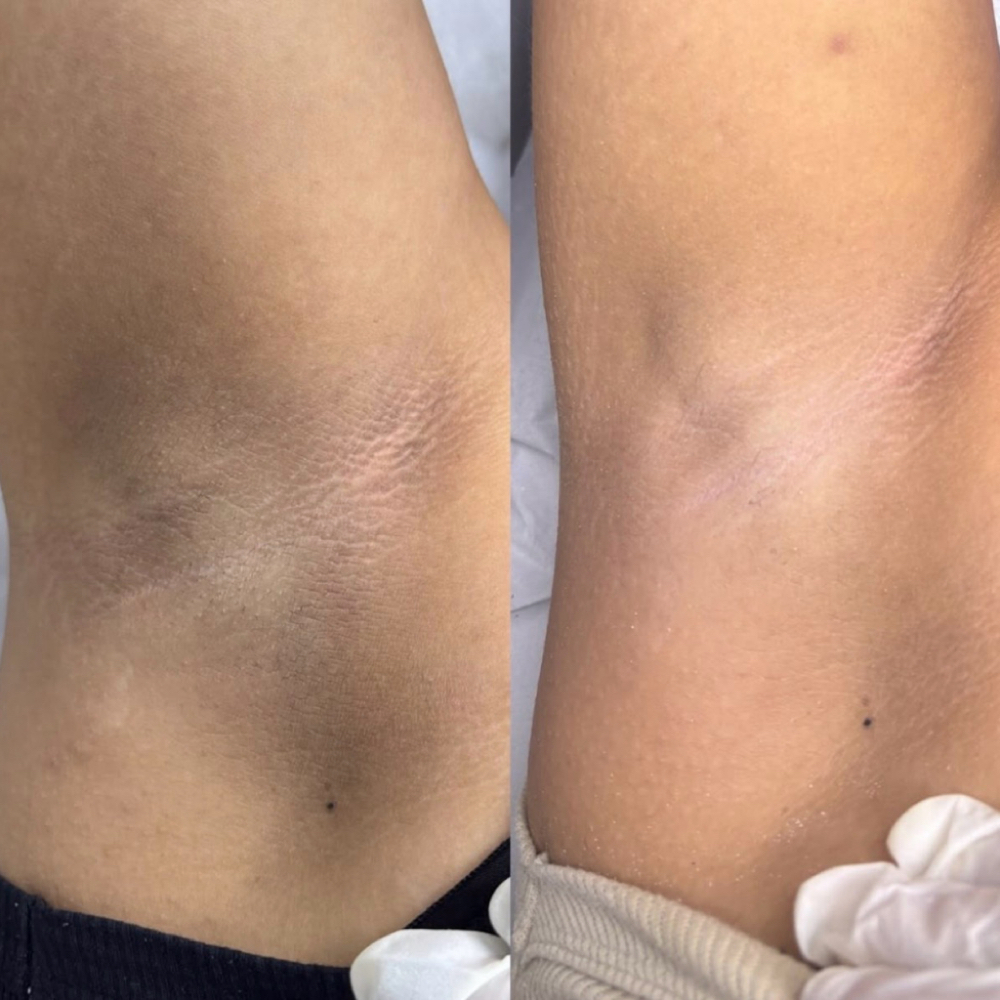 Brazilian Brightening Treatment at The Beauty Gossip at V2 Beauty in Fresno, CA
