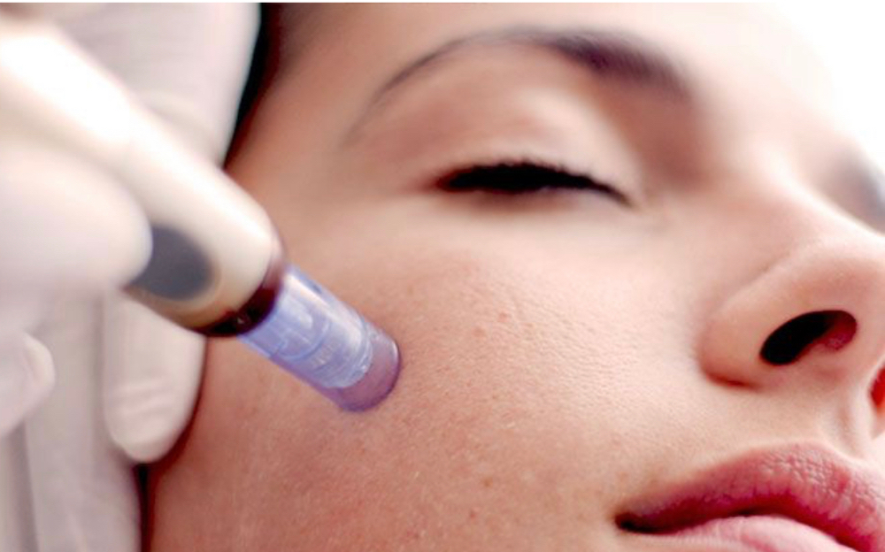Microneedling at Oasis Spa @ Ironwolf in Lake Havasu City, AZ