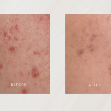 Acne Boot Camp at A Shear Thing Beauty Collective in The woodlands, TX