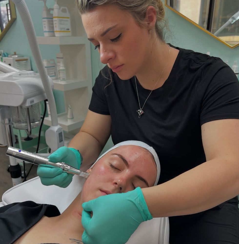 Microneedling