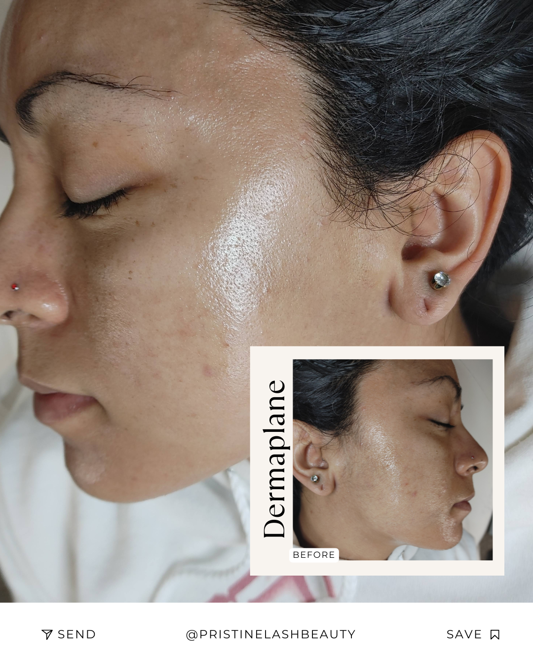 Dermaplane Facial