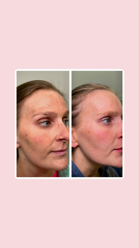 BioRePeel “No Down-Time” Peel
