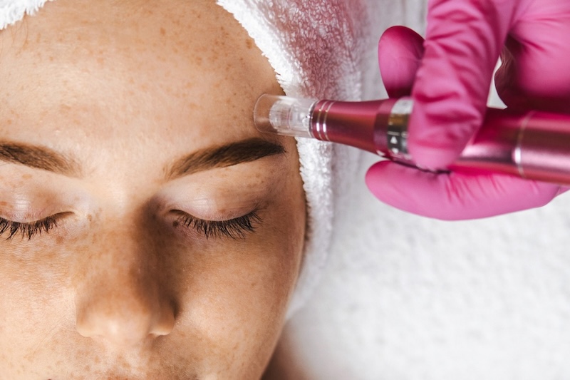 Microneedle Collagen Therapy