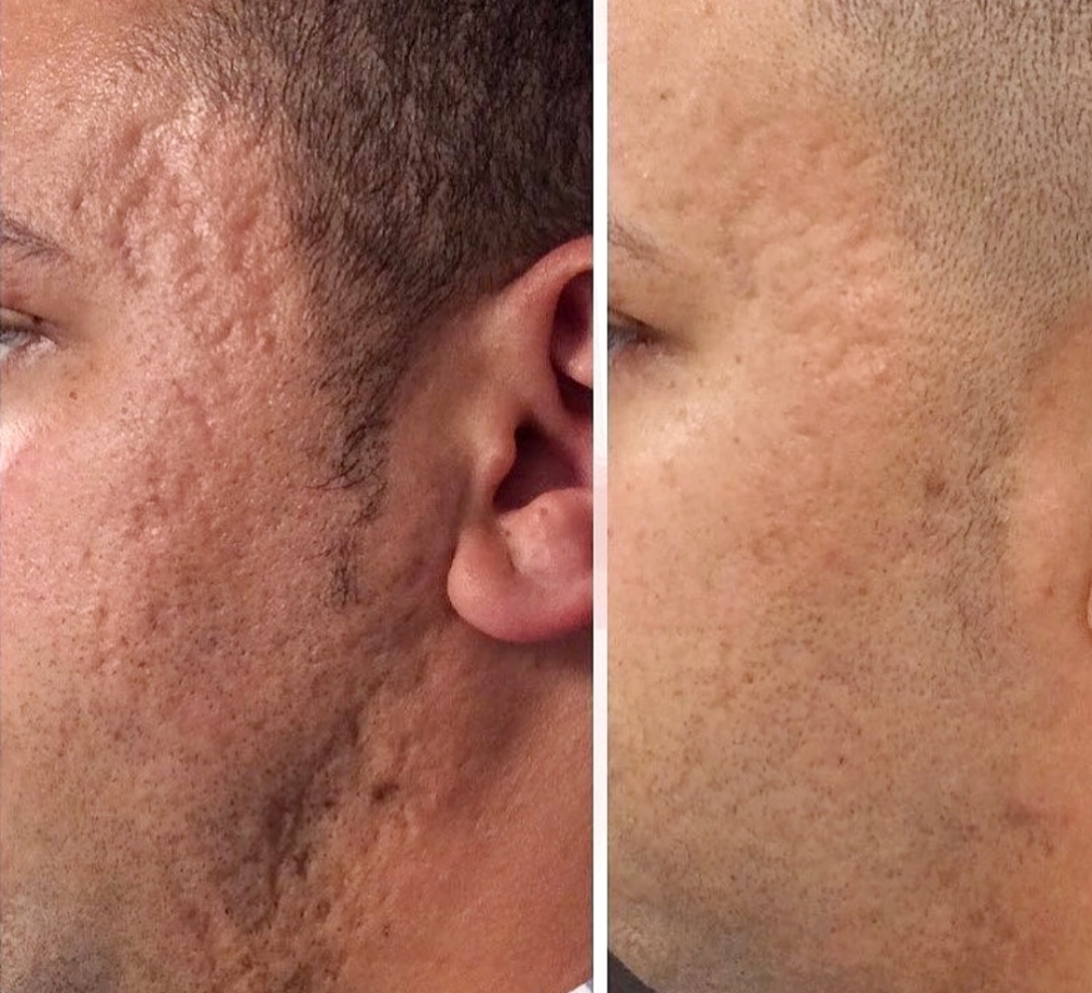 Microneedling Collagen Induction