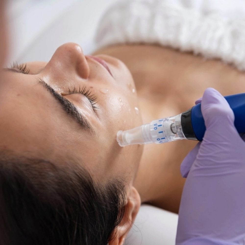 Microneedle Collagen Therapy at The Skin Mage Spa in Dallas, GA