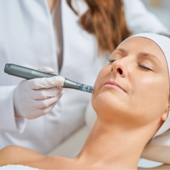 Microneedling at SKNN STUDIO in Methuen, MA