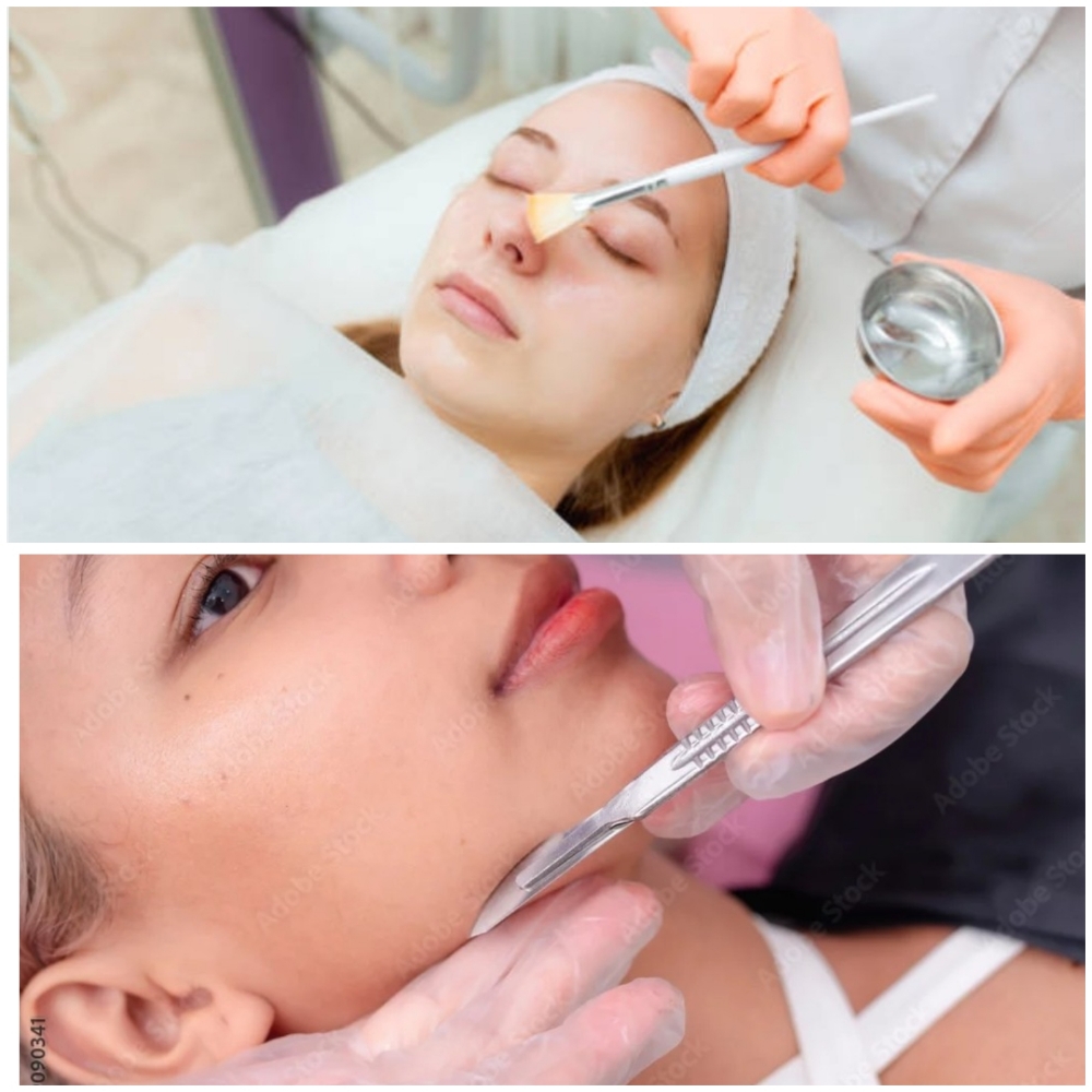 Microneedling & Chemical Peel