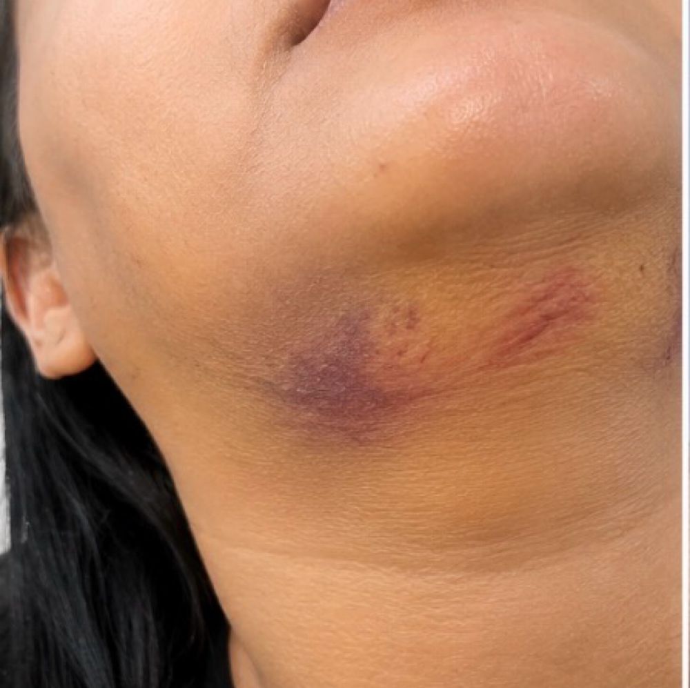 Chin Post-Op Recovery at Healing Touch by Tasha in Tarzana, CA
