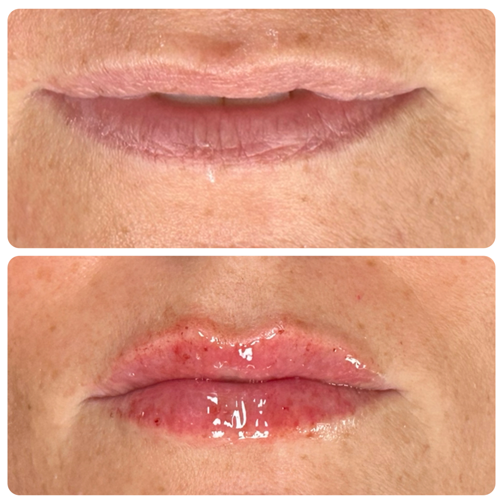 Micro-needling 1 ML