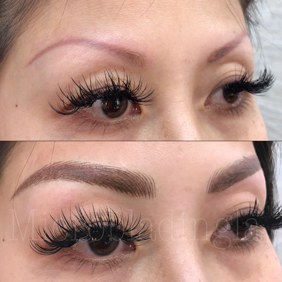 Brow Correction