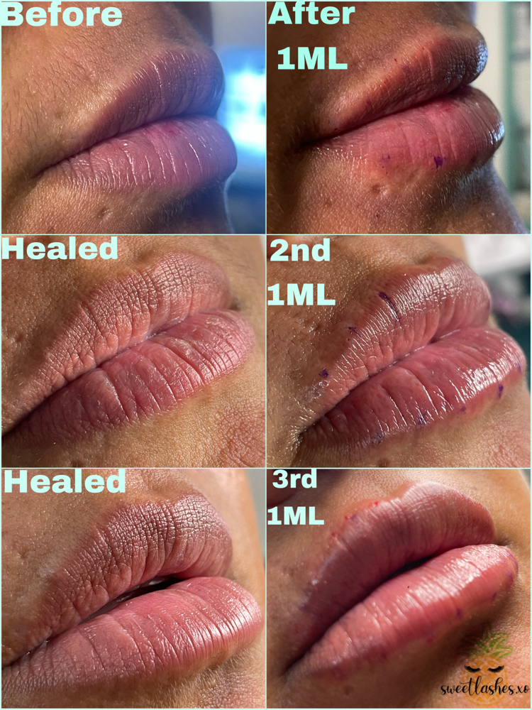 Needless Lip Filler 1.5ml