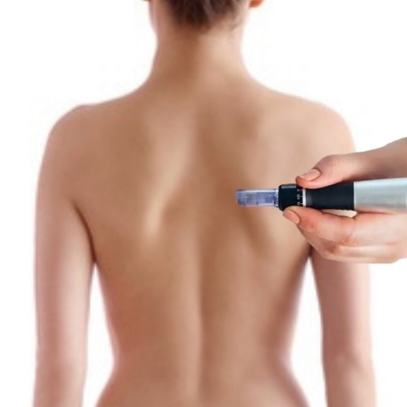 3 Back MicroNeedling Session