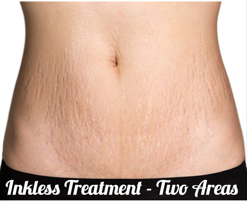 Scar/Stretch Mark Microneedling