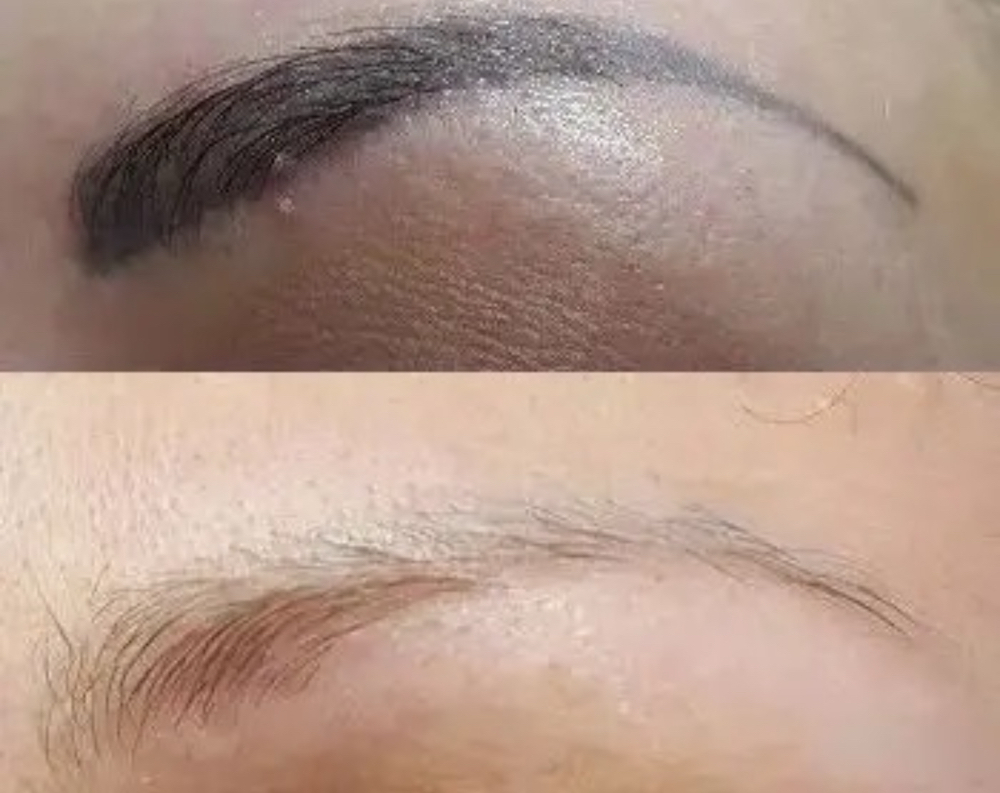 Emergency PMU Removal