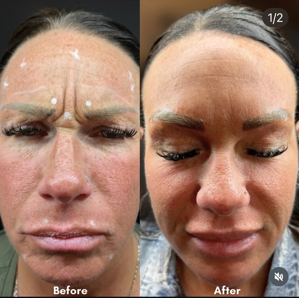 Tox Full Face Lift