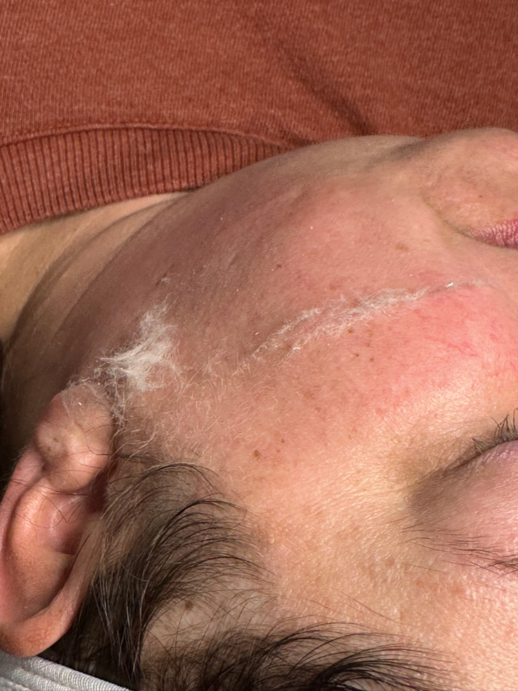 Dermaplane