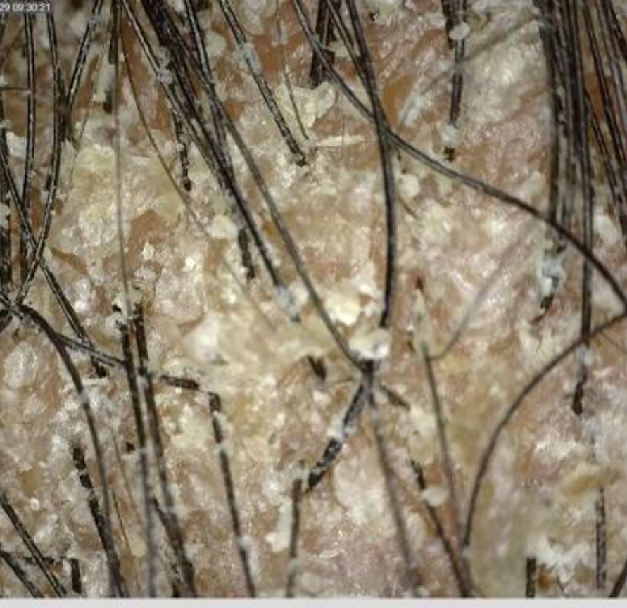 Dandruff Removal Head Spa