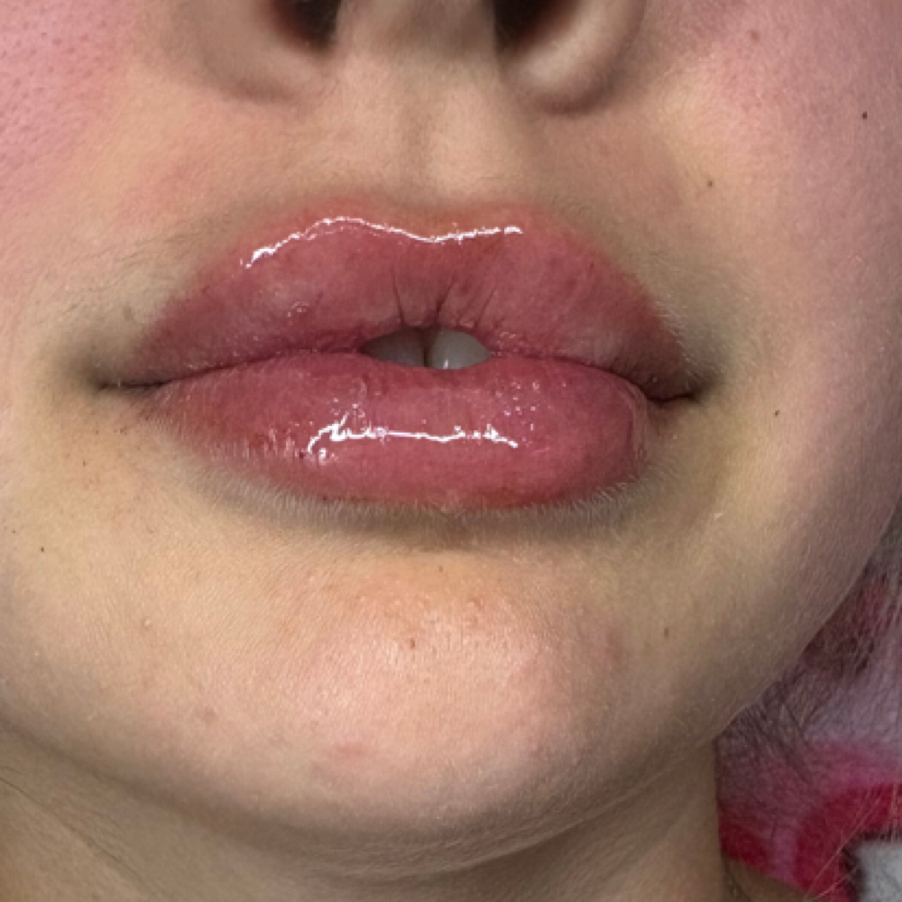 Lip Filler Touch Up 💉 at Domain Lips N Lashes in Corpus Christi, TX