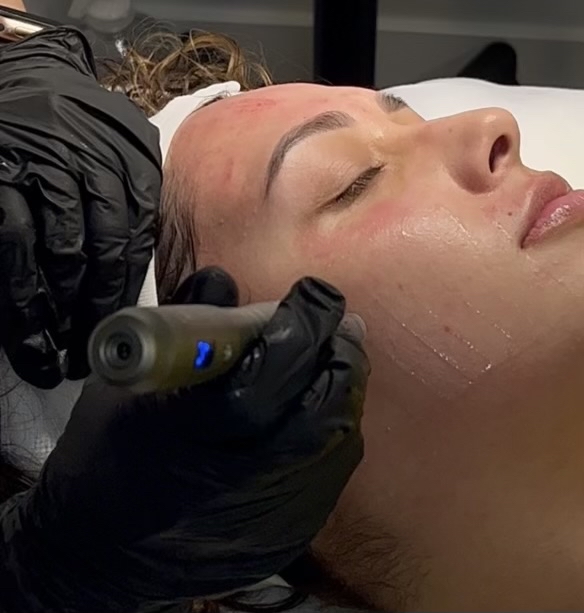 Microneedling